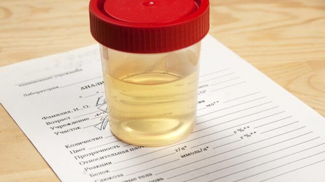 Urine analysis for high blood pressure